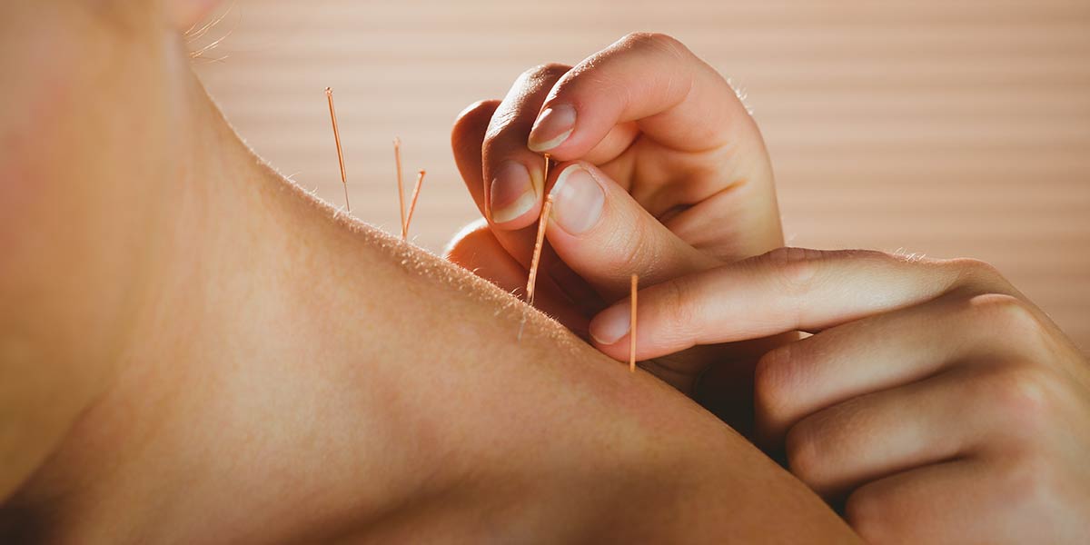 Acupuncture